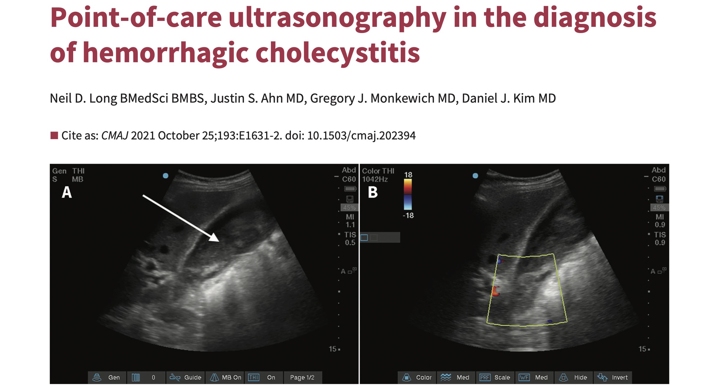 Hemorrhagic%20Cholecystitis%20CMAJ