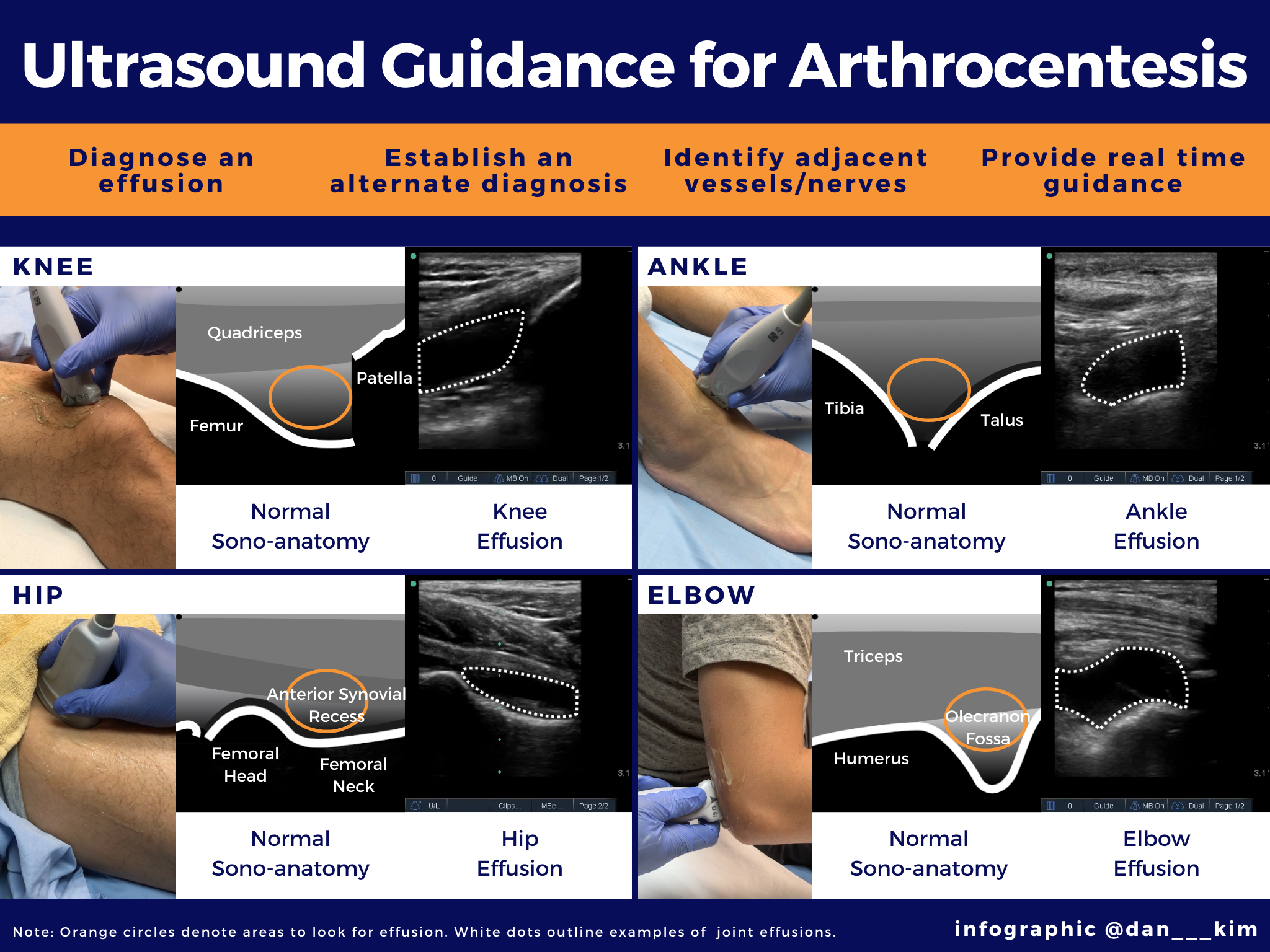 Just%20the%20Facts%20US%20Arthrocentesis%20Infographic